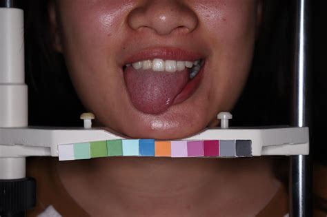 Crenated tongue adalah  Echynocyte (Burr cell, crenated cell, sea-urchin cell) merupakan eritrosit dengan tonjolan duri yan lebih banyak (10-30 buah), berukuran sama, tersebarDefinisi Fissured Tongue Fissured tongue seringkali juga dikenal dengan scrotal tongue atau plicated tongue adalah sebuah kondisi varian normal yang di tandai dengan terdapatnya celah dalam pada dorsum lidah dan umumnya tidak ada